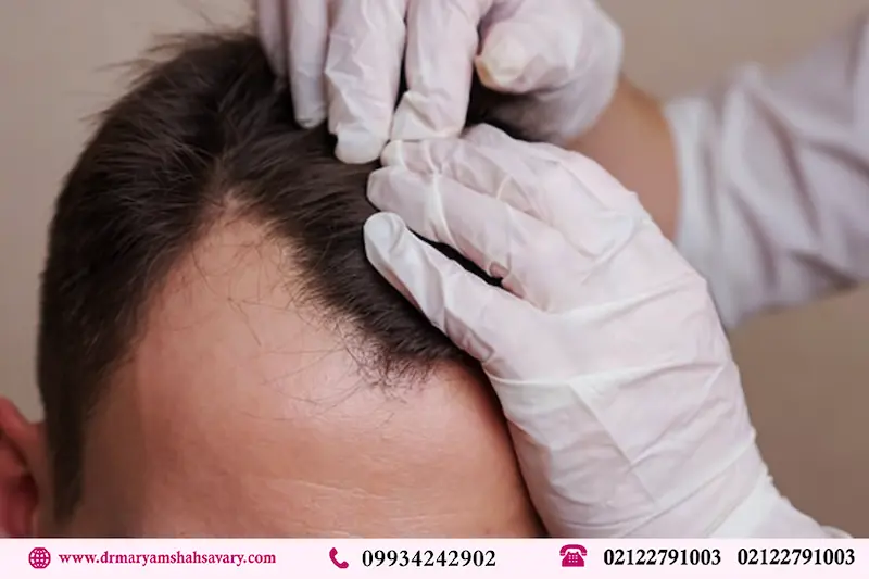 بهترین مرکز کاشت مو آقایان در فرمانیه تهران